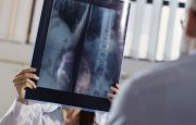 Bone Loss After Menopause