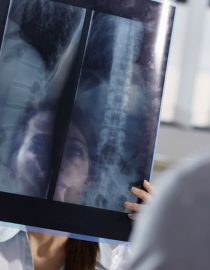 Have You Experienced Bone Loss After Menopause? Have You Experienced Bone Loss After Menopause?